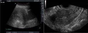 Imágenes ecográficas de engrosamiento endometrial por vía pélvica (izquierda) y transvaginal (derecha).
