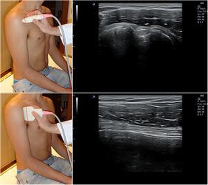 Posición del hombro y de la sonda para el estudio del tendón de la porción larga del bíceps; imágenes normales en sección transversal (arriba) y longitudinal (abajo).