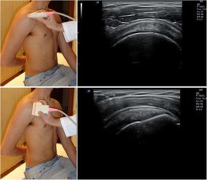 Posición del hombro y de la sonda para el estudio del tendón del supraespinoso; imágenes ecográficas normales en sección transversal (arriba) y longitudinal (abajo).