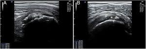 Imagen ecográfica de corte longitudinal (izquierda de la imagen) y transversal (derecha de la imagen) en un caso de tendinitis calcificante del supraespinoso.