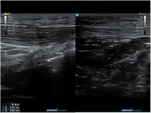 Imagen comparativa de un tendón rotuliano derecho (a la izquierda de la figura) con aumento de grosor e hipoecogenicidad por tendinitis, e izquierdo (a la derecha de la figura) normal.