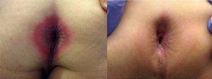 Lesión en área perianal antes (izquierda) y después (derecha) del tratamiento.