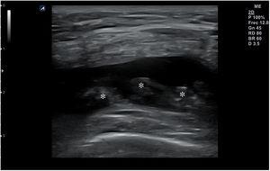 Imagen de derrame articular en cuyo seno se aprecia hipertrofia de la membrana sinovial (asteriscos).