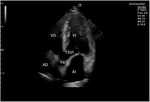 Corte ecográfico de plano apical de 5 cámaras. AI: aurícula izquierda; AD: aurícula derecha; VI: ventrículo izquierdo; VD: ventrículo derecho; TSVI: tracto de salida del ventrículo izquierdo; Va: válvula aórtica