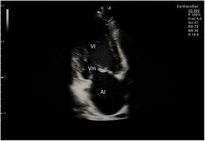 Corte ecográfico de plano apical de 2 cámaras. AI: auricula izquierda; VI: ventrículo izquierdo; Vm: válvula mitral.