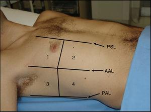 Representación de las zonas o áreas ecográficas para el estudio del pulmón. PSL: línea paraesternal; AAL: línea axilar anterior; PAL: línea axilar posterior