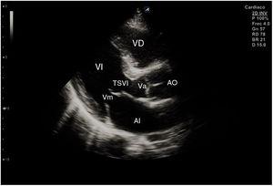 Corte ecográfico de plano paraesternal de eje largo. VD: ventrículo derecho; VI: ventrículo izquierdo; AI: aurícula izquierda; TSVI: tracto de salida del ventrículo izquierdo; Va: válvula aórtica; Vm: válvula mitral