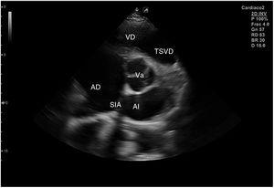 Plano paraesternal de eje corto: corte sobre válvula aórtica. Va: válvula aórtica; AI: aurícula izquierda; AD: aurícula derecha; SIA: septo interauricular; VD: ventrículo derecho; TSVD: tracto de salida del ventrículo derecho