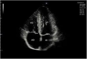 Corte ecográfico de plano apical de 4 cámaras. AI: aurícula izquierda; AD: aurícula derecha; VI: ventrículo izquierdo; VD: ventrículo derecho; Vt: válvula tricúspide; Vm: válvula mitral
