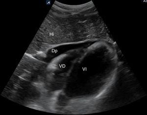 Derrame pericárdico en vista subxifoidea. Dp: derrame pericárdico; Hi: hígado; VD: ventrículo derecho; VI: ventrículo izquierdo.