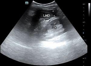 Líquido libre en receso peritoneal de Morrison (hepatorrenal). LHD: lóbulo hepático derecho; RD: riñón derecho; **: líquido libre.