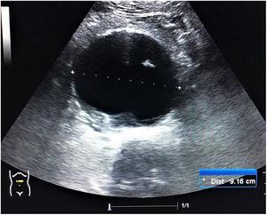 Imagen de corte transversal en la línea media abdominal que muestra un aneurisma de aorta abdominal de 9,16 cm.