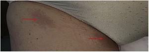 En esta imagen se pueden apreciar 2 lesiones (flechas), tipo manchas 2-3cm aproximadamente, que aparecieron posteriormente a la lesión de la región lumbar.