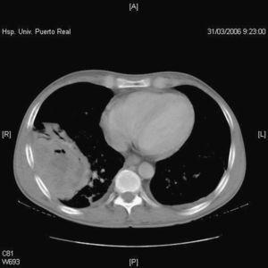 Tomografía computarizada de tórax: tumoración abscesificada en lóbulo inferior derecho con zonas sugerentes de necrosis central.
