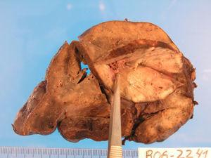 Pieza quirúrgica de lobectomía inferior derecha: aspecto macroscópico compatible con una neoplasia bronquial.