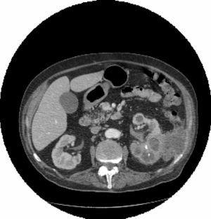 Tomografía computarizada abdominal. Masa renal izquierda que contacta con la pared abdominal.