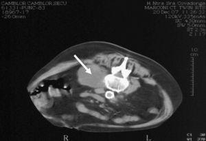 Tomografía computarizada de abdomen previa al drenaje percutáneo, donde se observa una colección en el psoas derecho (flecha, el paciente está en decúbito prono).
