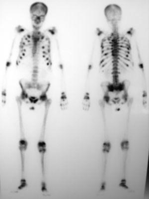 Gammagrafía ósea con 99mTC-HDP con múltiples depósitos patológicos (parrilla costal, articulaciones costo-vertebrales, hombros, codos, carpos, sacroilíacas, cadera, rodillas y tarsos).