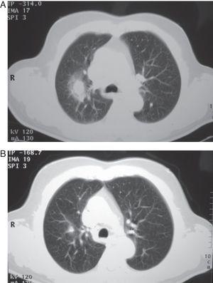 (A) Thoracic CT showed a nodule of 2cm in upper right lobe with adjacent pneumonitis. (B) Thoracic CT fourteen days after onset revealed resolution of nodular image.