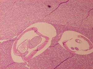 Granuloma inflamatorio con 2 cortes transversales de 2 gusanos de Dirofilaria sp. teñido con hematoxilina-eosina.
