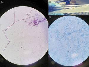 (A) Gram stain from the material drained from the skin abscess. (B) Sabouraud medium culture and (C) Lactophenol cotton blue wet mount preparation.