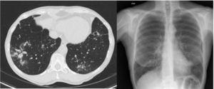 Paciente 3. Tomografía computarizada y radiografía torácica: bronquiectasias en lóbulo superior, lóbulo medio y língula; nódulos en lóbulo inferior izquierdo.