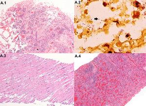 Fatal MDR A. baumannii infection: microbiological and pathological results of post-mortem samples. Histological images of relevant findings. (A.1) Lung with pyogenic pneumonia (haematoxylin and eosin, 100×); (A.2) Gram negative bacteria (A. baumannii) pneumonia (arrow) infecting the lung (gram stain, 1000×); (A.3) heart with hypertrophy (haematoxylin and eosin, 100×); (A.4) spleen with lymphocytic depletion and congestion (haematoxylin and eosin, 100×).