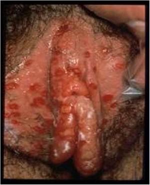Lesiones ulcerosas en vulva. Modificado de Garland y Steben13.