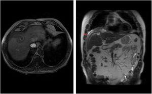 RM hepática: la imagen de la izquierda muestra una lesión característicamente hiperintensa en secuencia T1 sin contraste intravenoso. A la derecha se aprecia en secuencia T2 el absceso con la fístula posdrenaje.