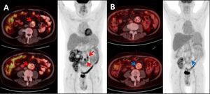 18F-FDG PET/CT showing: (A) Maximum intensity projection (MIP) and Axial-fused PET/CT images: two foci of high intensity FDG uptake in the aortic graft (SUVmax 17.79 and 9.46 respectively), consistent with infection of the graft (red arrows). (B) Same patient and same projections showing: significant decrease in FDG uptake after treatment (SUVmax 3.70 and 2.78 respectively) (blue arrows).