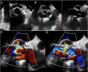 (A) Transesophageal echocardiography (longitudinal plane) showing a circumferential abcess 180° around the aortic prosthesis; (B) X plane imaging with transesophageal echocardiography showing the periprosthetic abscess. (C and D) Transesophageal echocardiography (horizontal plane) showing fistula from the ventricular outflow tract to the ascending aorta on a color Doppler map.