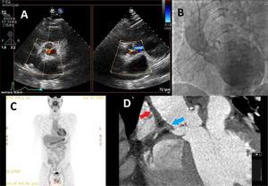 A) Insuficiencia aórtica severa en ecocardiograma transtorácico. B) Aortografía donde se observa una aorta no dilatada, oclusión en el origen de la coronaria derecha (CD) y una regurgitación de grado severo. C) 18FDG-PET/TC con hipercaptación significativa en aorta ascendente. D) AngioTC en el que se aprecia un engrosamiento de la pared aórtica (flecha roja) y oclusión de la CD (flecha azul). 18F-FDG PET/TC tomografía por emisión de positrones con 18-fluorodesoxiglucosa; Angio-TC: angiografía por tomografía computarizada.