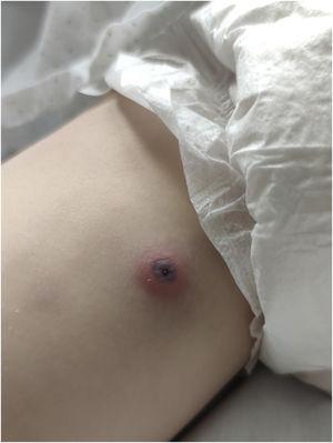 Necrotic eschar on the inner side of the right thigh, surrounded by a slightly raised inflammatory halo.