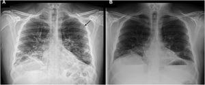 Radiografía de tórax, mostrando: A) afectación intersticial bilateral, con presencia de cámara de neumotórax (flecha negra). B) Desaparición de la cámara de neumotórax previamente visualizada.