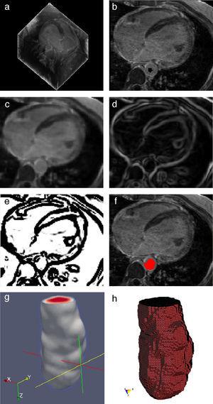 Preproceso y segmentación para el modelado geométrico de la aorta descendente (a) Vista 3D original de imágenes originales de IRM cardiovascular. (b) Vista de un corte axial de (a) con la implantación de un snake en la zona de la aorta. (c) Filtrado del ruido de (b) con la técnica de difusión anisotrópica. (d) Imagen módulo gradiente de (c). (e) Imagen sigmoid de (d). (f) Segmentación de aorta descendente empleando Level Set. (g) Vista tridimensional en ParaView de la aorta descendente segmentada. (h) Vista de la malla en GiD del volumen de la aorta descendente.