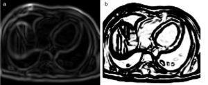 Reforzado de bordes empleando el filtro sigmoid. (a) Imagen módulo gradiente de IRM cardiovascular l. (b) Imagen (a) con los bordes reforzados empleando en itk::SigmoidImageFilter.