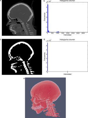 Técnica de umbralización aplicada a imágenes de TC cráneo-facial. (a) Vista original de un corte sagital. (b) Histograma de imagen a. (c) Imagen resultante de umbralizar imagen (a) con un umbral T=1235. (d) Nuevo histograma de la imagen binaria (c). (e) Vista 3D del volumen del hueso cráneo-facial y parte de las vértebras segmentado con umbralización.