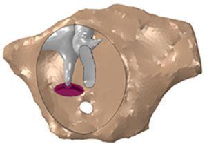Vista da CT com a membrana timpânica à transparência, evidenciando os ossículos no seu interior.