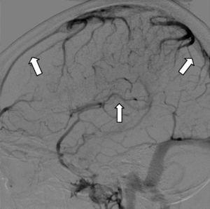 Angiografía cerebral con sustracción digital en fase venosa. Ausencia de llenado del SSS y SSI. Corresponde a TVC de ambos senos (flechas).
