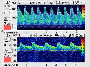 Doppler transcraneal. Panel A) Registro ultrasonográfico del día 16 cuando aparece la focalidad cortical, en el que se observan velocidades medias de 165cm/s. Panel B) La terapia triple H normalizo las velocidades (52cm/s).