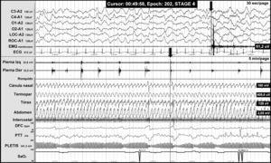 Registro polisomnográfico nocturno de un paciente con malformación de Chiari tipo I en el que se objetivan movimientos periódicos de las piernas. La línea gris al final de uno de los movimientos de piernas (flecha) se asocia a activación simpática (objetivada en los canales de frecuencia cardiaca [DFC], transición de la onda de pulso [PTT] y la amplitud de la onda de pulso [PLETIS]) y a un microdespertar cortical visible en los canales de electroencefalografía.