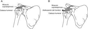A) Hombro normal: el músculo supraespinoso mantiene la cabeza del húmero en la fosa glenoidea. B) Subluxación del hombro: durante la fase inicial de hemiplejía, el músculo supraespinoso se encuentra fláccido. El peso del brazo puede hacer que la cabeza del húmero se subluxe en sentido inferior respecto a la fosa glenoidea.