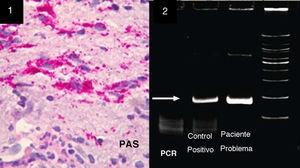 1) Biopsia cerebral y de sinequias ventriculares mostrando a los linfocitos y macrófagos llenos de periodic acid-Schiff (PAS+), consistentes con microorganismos de TW. 2) Reacción en cadena de la polimerasa (PCR), detección del TW con ARN 16S. Estos oligonucleótidos permiten la detección de 160 pares de bases fragmentados en la presencia del ADN bacteriano. La flecha blanca marca la intensa banda blanca, de la columna de nuestro paciente problema comparado con un control positivo.