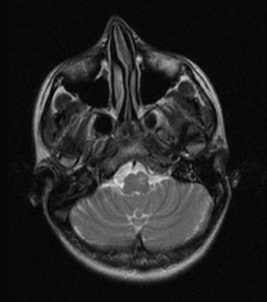Imagen RM axial potenciada en T2. Se visualiza hiperintensidad, aumento de volumen y modificación del contorno del bulbo en relación con hipertrofia del núcleo olivar inferior izquierdo.