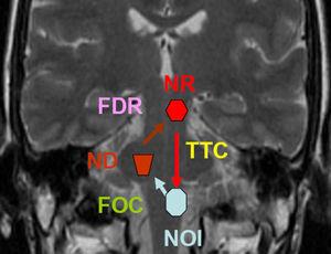 Imagen RM coronal T2 con esquema ilustrativo del triángulo de Guillain-Mollaret. FDR: fibras dentorúbricas; FOC: fibras olivocerebelosas; ND: núcleo dentado; NOI-núcleo olivar inferior; NR: núcleo rojo; TTC: tracto tegmental central.