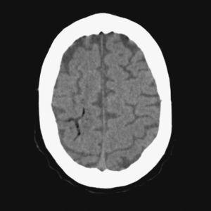 TC cerebral realizada 1h después del inicio de los síntomas. Imágenes serpiginosas con densidad aire en el área cortical parietal.