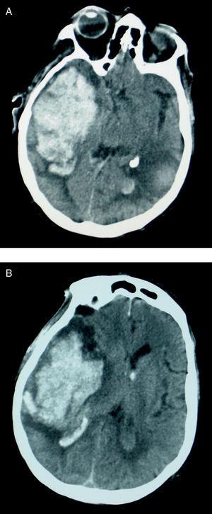 Hemorragia intracerebral recurrente en amiloidosis primaria | Neurología