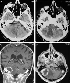 A-B: TC sin y con contraste mostrando una lesión en hemisferio cerebeloso derecho. C-D: RM con contraste correspondientes al mismo paciente (pacienteN° 18).