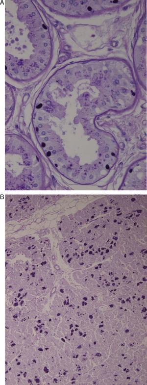 A) Biopsia de la piel axilar (Tinción PAS a un aumento de 2×400): se observan formaciones redondeadas intensamente PAS+en las células epiteliales de las glándulas apocrinas y en los conductos de las glándulas ecrinas correspondientes a cuerpos de Lafora. B) Corazón (Tinción PAS a un aumento 1×200). Múltiples cuerpos de Lafora en los miocitos.