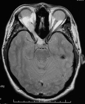 Resonancia magnética cerebral en secuencia densidad protónica y corte axial que pone de manifiesto una tumoración del nervio óptico derecho con prolongación hasta quiasma óptico característica de glioma del nervio óptico en un paciente con neurofibromatosis tipo 1.